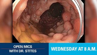 Open Mics with Dr Stites  Familial Adenomatous Polyposis [upl. by Akinnej]