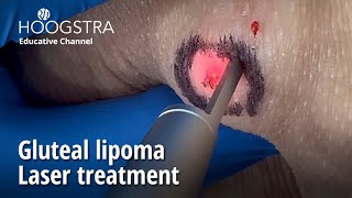 Gluteal lipoma  Laser treatment  24146 [upl. by Esirahs]