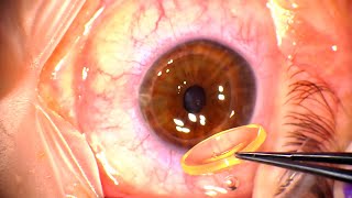 Corneal Transplant Penetrating Keratoplasty for Advanced Keratoconus and Corneal Infiltrates [upl. by Kcerred186]