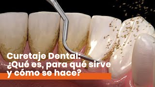 Curetaje Dental ¿Qué es y cómo se hace [upl. by Atina]