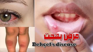 مرض بهجت Behçets disease [upl. by Sanchez908]