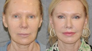 Awake Painless Scarless Mini Facelift amp Necklift Lip Lift by Beverly Hills Best Plastic Surgeon [upl. by Hillier]