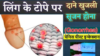 लिंग पर दाने खुजली सूजन इन्फेक्शन का दवा  balanitis medicine  gonorrhea  STD infection [upl. by Nee]