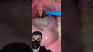 Using A WATER PIK To Remove Tonsil Stones [upl. by Bruce]