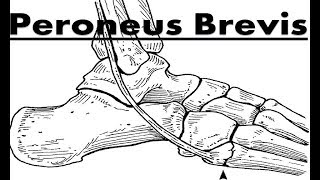 Peroneus Fibularis Brevis Tendinitis Pain Home Treatment Guide [upl. by Aicirt]