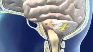 Brainstem Herniation [upl. by Naquin]