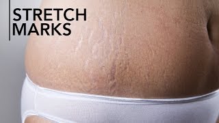 How To Get Rid Of Stretch Marks Ingredients that work for stretch marks  From Causes To Treatment [upl. by Elimac]