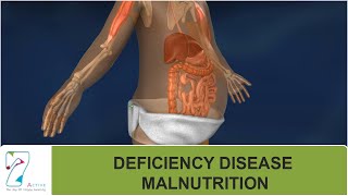 DEFICIENCY DISEASE  MALNUTRITION [upl. by Gnes296]