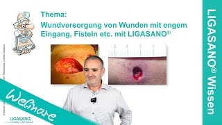 Wie komme ich da hin Wundversorgung von Wunden mit engem Eingang Fisteln  Webinar 14092022 [upl. by Keynes721]