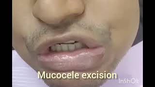 Surgical removal of mucocele on lower lip at affordable cost in Kolkata [upl. by Gomez]