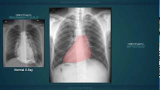 Situs Inversus with Dextrocardia Explanation of Chest Xray Findings [upl. by Birkle]