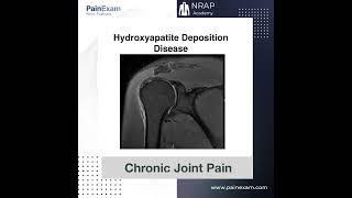 Hydroxyapatite Deposition Disease [upl. by Antebi]