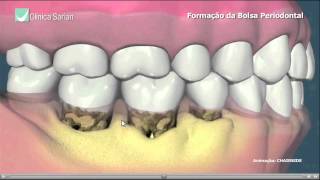 Formação da Bolsa Periodontal [upl. by Fishback403]