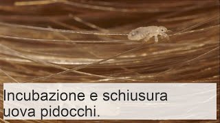 Periodo di incubazione e trattamento della pediculosi umana durata e cure per i pidocchi [upl. by Omsoc]