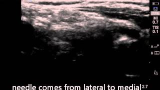 ULtrasound guided superficial cervical plexus block [upl. by Olag]