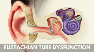 What is Eustachian Tube Dysfunction [upl. by Noiz]