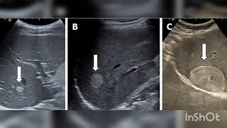 Liver Hemangioma [upl. by Noval831]