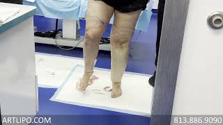 Cankles amp Knees Liposuction  Lipedema Legs  Lipo 360°  Expert Dr Thomas Su [upl. by Aelyak447]