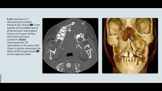 Neurofibromatosis neckㅣfibrous dysplasiaㅣCHARGE syndrome [upl. by Burkitt477]