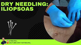 Dry Needling Iliopsoas [upl. by Kuebbing907]