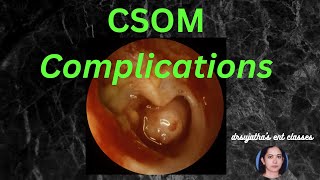 037 Complications of Suppurative Otitis Media csom [upl. by Ultann]