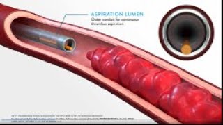 JETi Hydrodynamic Thrombectomy System Method of Action MOA Animation [upl. by Arte96]