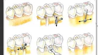 Resective Osseous Surgery [upl. by Chaddie]