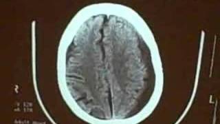 Subdural hematoma [upl. by Aleakim195]