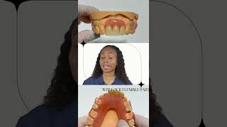 Flexible Partial Dentures for the Front Missing Teeth [upl. by Cyrillus339]