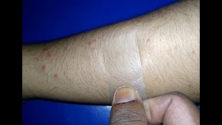 Diascopy Or Glass Test  Differentiate Erythematous or PurpuricPetichial lesion [upl. by Latsyek319]