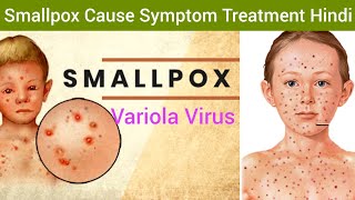 Smallpox Variola Cause Symptoms Diagnosis Treatment in Hindi  Smallpox Hindi  What is Smallpox [upl. by Uchida]