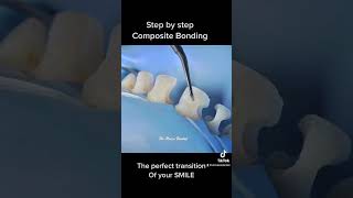 Teeth Composite bonding step by step [upl. by Timmons902]