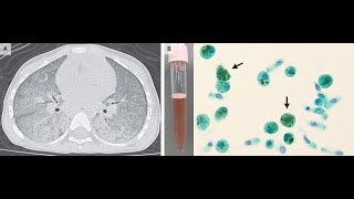 Idiopathische pulmonale Hämosiderose [upl. by Airetal368]