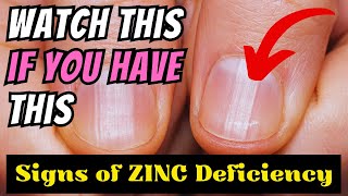 10 Symptoms Of Zinc Deficiency You Probably Dont Know About [upl. by Jessie]