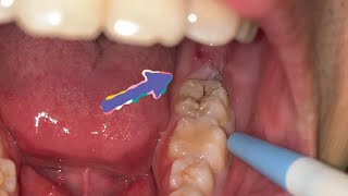 Odontectomy  Wisdom Tooth Removal  Dentist  Dokter Gigi Tri Putra [upl. by Yancey]