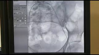 Thrombus aspiration and catheter directed thrombolysis Deepak Heart Institute [upl. by Yslehc57]