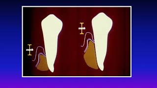 Tooth supported overdentures and remaining roots by Prof Dr Zainab Elshorbagy [upl. by Emmalyn189]