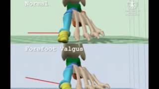 Comparison of Normal Gait to Forefoot Valgus Gait [upl. by Ilojna]