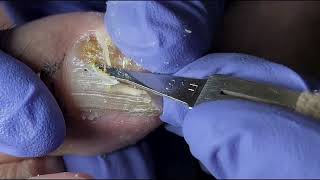 Ingrown Toenail Removal  Pedicure Treatment and Very Satisfying  Best Satisfying Nail Cutting [upl. by Inuat]