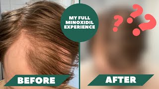 I Have Been Using Minoxidil For 1 Year And Here Are The Results  My Full Minoxidil Experience [upl. by Derick]