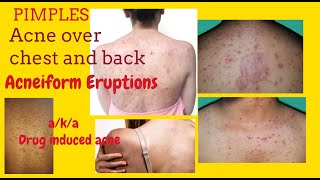 Pimples on chest and back or Acneiform Eruptions aka Drug induced acne  with Teratogenic Drugs [upl. by Malvie]