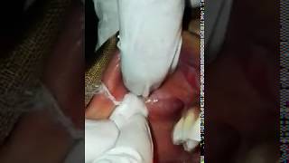 A demonstration of parotid papilla by Dr Nadeem Ahmed [upl. by Yecaj175]