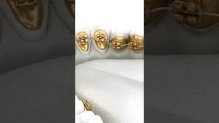 Fixed orthodontist treatment orthotreatment dentist smile orthocare teethwhitening [upl. by Lonne]