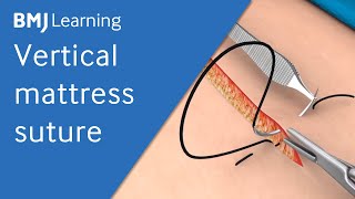 Vertical Mattress Suture  BMJ Learning [upl. by Terraj410]