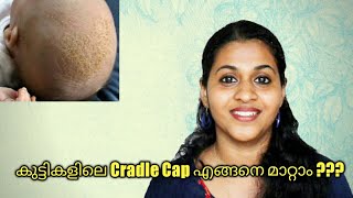 How to Cure Cradle Cap in Babies [upl. by Cyprus]