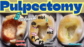 Pulpectomy 🟢 amazing maxillary molar with 5 root canals ⚪️ access opening 🟡 cmp 🔵 obturation [upl. by Leanard]