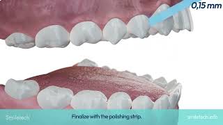 quotSmiletech Interproximal Reduction IPRStripping in Invisible Orthodontics  ENGquot [upl. by Hux126]