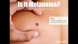 Is it melanoma [upl. by Eadnus]