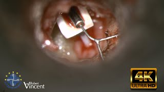 Oval Window Tympanosclerosis with Total Missing Ossicular Chain MRPtoStapedotomy Procedure [upl. by Cartie]