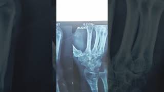 scaphoid fracturefracture wrist fracture anatomy osteology doctors mbbs medical [upl. by Lasyrc]